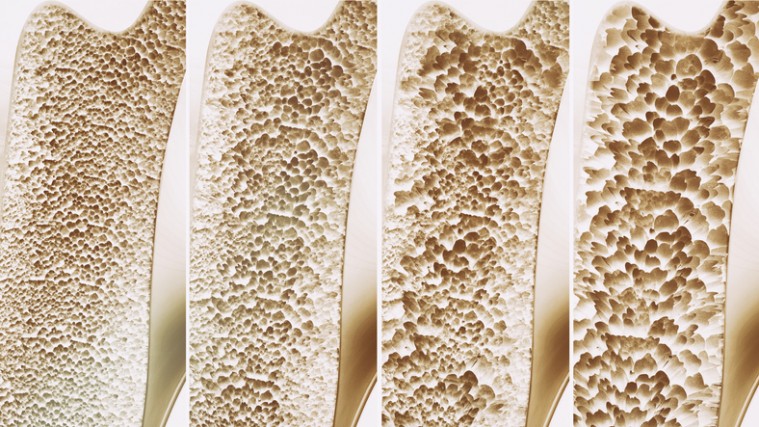 Osteoporosis, señales de alerta de esta epidemia silenciosa
