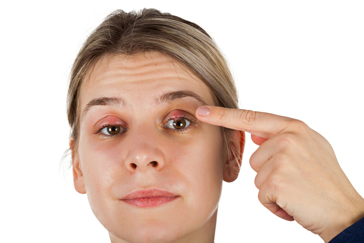 Razones por las que sale una chalación en el ojo