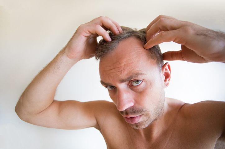 Como disimular la alopecia