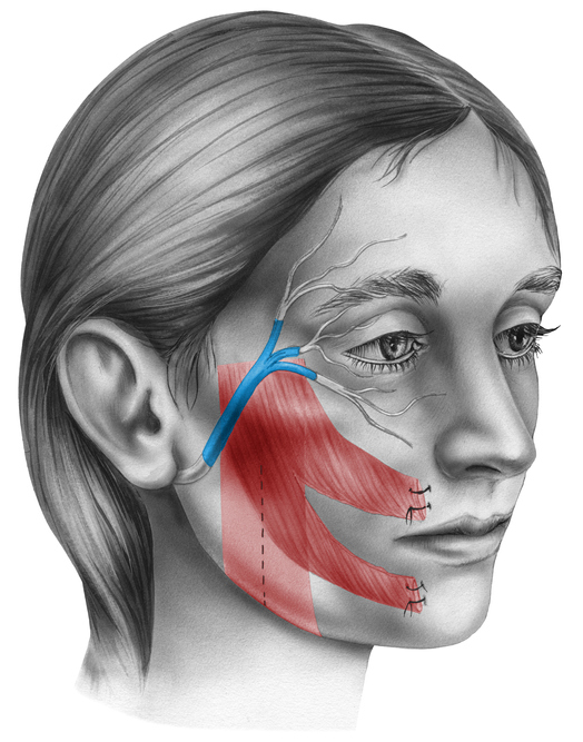 Causas y síntomas de la parálisis facial