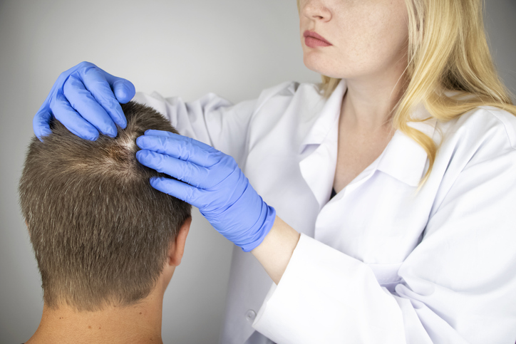 La importancia de consultar a un especialista al primer síntoma de alopecia