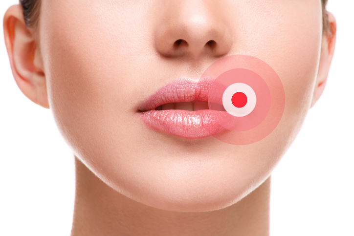 Herpes labial: cómo combatir las calenturas desde el primer síntoma