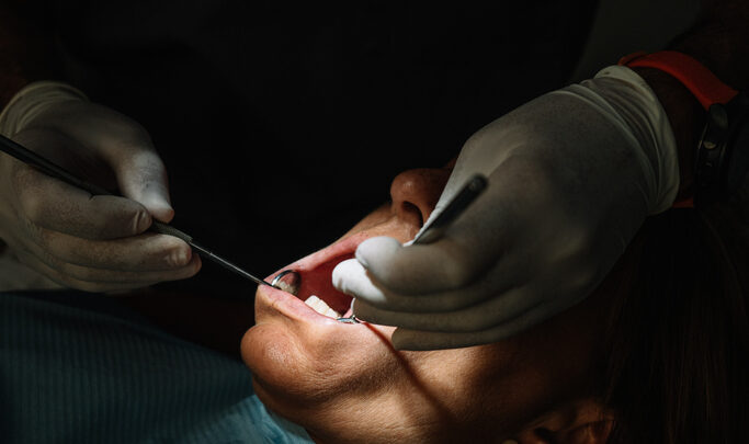 Atrofia ósea dental: por qué ocurre y cómo afecta a la posibilidad de colocar implantes